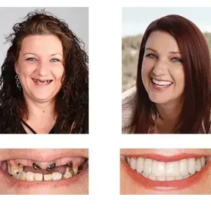 🦷 Denturelix™ Custom-Fit Functional Dentures 😁 Smile with Confidence