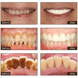 SmileFitPro™ Niacinamide Whitening Toothpaste