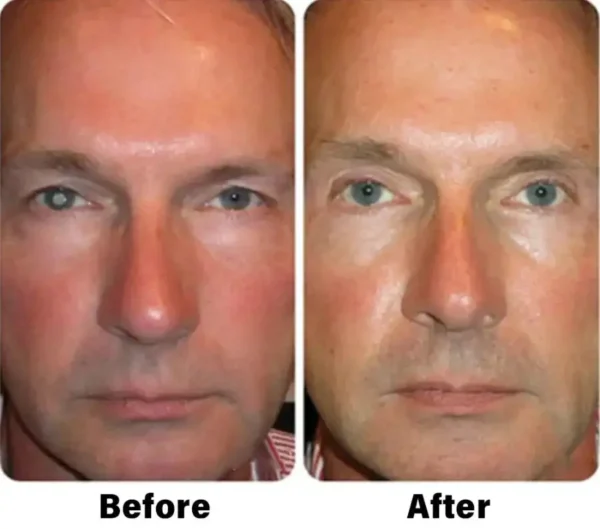 NESLEMY™ Nano Vision Repair Eye Serum ✅FDA Approved(Suitable for presbyopia, dry eye syndrome, glaucoma, and cataracts)