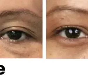 NESLEMY™ Nano Vision Repair Eye Serum ✅FDA Approved(Suitable for presbyopia, dry eye syndrome, glaucoma, and cataracts)