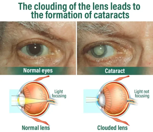 NESLEMY™ Nano Vision Repair Eye Serum ✅FDA Approved(Suitable for presbyopia, dry eye syndrome, glaucoma, and cataracts)
