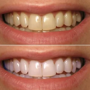 Smileasego™ Nano-Hydroxyapatite Teeth Whitening Strips, Enamel Repairing & Sensitivity Free Formula (28 Strips)