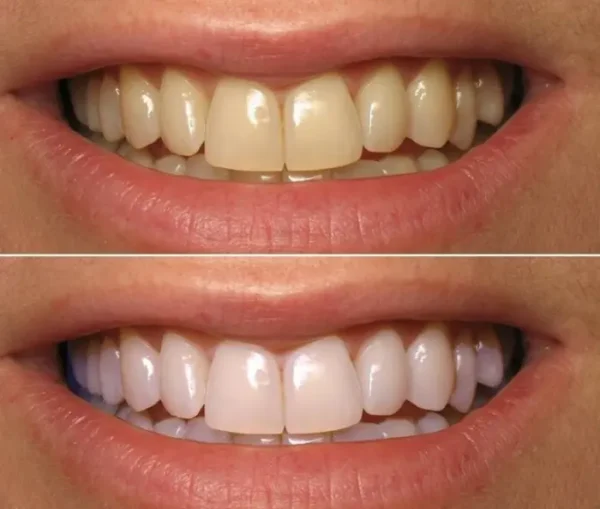 Smileasego™ Nano-Hydroxyapatite Teeth Whitening Strips, Enamel Repairing & Sensitivity Free Formula (28 Strips)