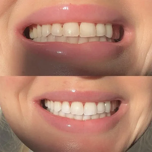 Smileasego™ Nano-Hydroxyapatite Teeth Whitening Strips, Enamel Repairing & Sensitivity Free Formula (28 Strips)