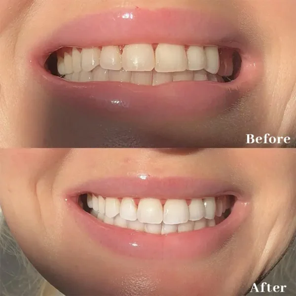 Smileasego™ Teeth Whitening Strips