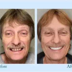 TrueEase™ Dentures
