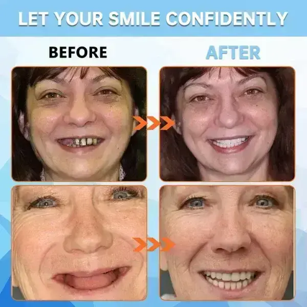 ROSOPL™ Adhesive teeth (upper and lower)