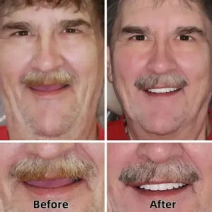 SmileFitPro™–Advanced Custom-Fit Functional Dentures