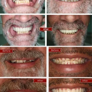 FLASH SALE: Fix Your Smile in 30 Seconds — 👨‍⚕Adjustable Snap-On Dentures😁