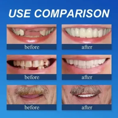 FOMONEST™ Full Denture with Strong Suctiond Custom-Fit Full Functional Dentures🦷