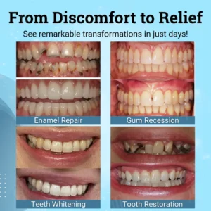 Smileasego Non-Surgical Gum