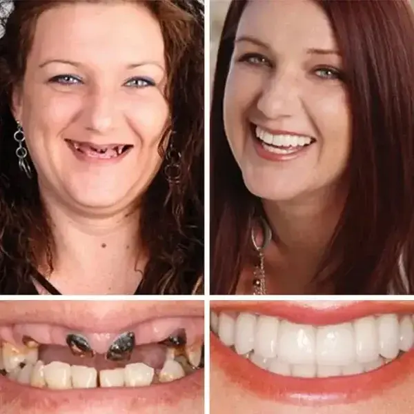 –Ends Today: 75% OFF! ⏰DarkFairy™ Medical Full Denture with Strong Suctiond Custom-Fit Full Functional Dentures🦷