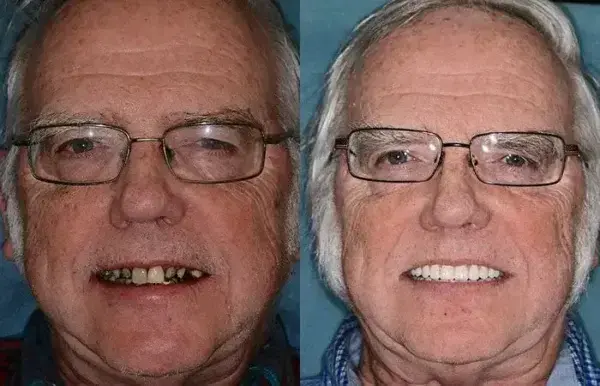 Vaxflite™ PREMIUM DENTURES
