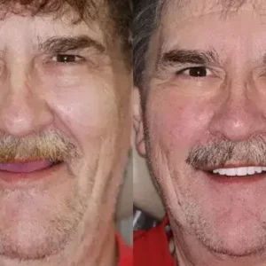 Vaxflite™ PREMIUM DENTURES