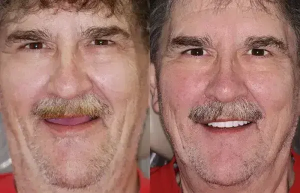 Vaxflite™ PREMIUM DENTURES