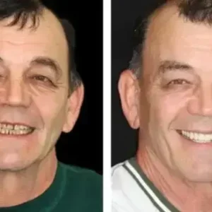 Vaxflite™ PREMIUM DENTURES