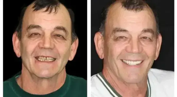Vaxflite™ PREMIUM DENTURES