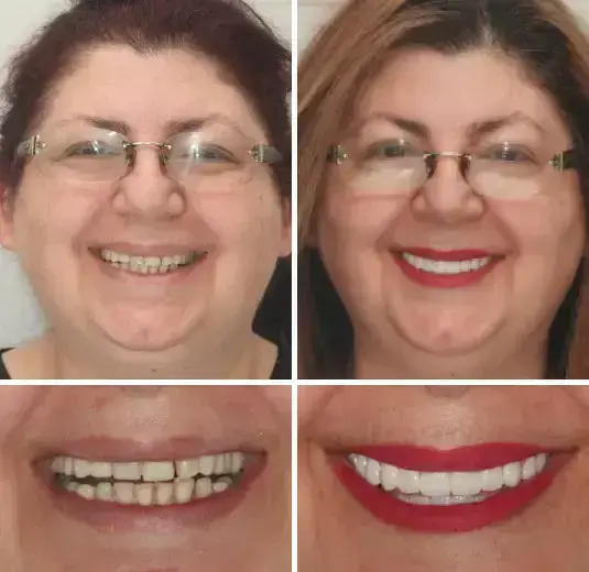 Vaxflite™ PREMIUM DENTURES